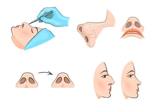 最新隆鼻手术方法，探索与解析